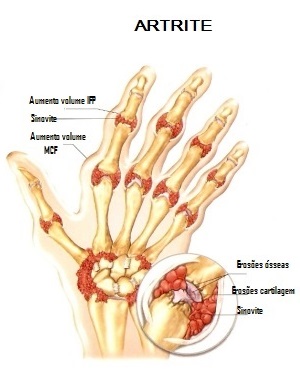 artrite e mão