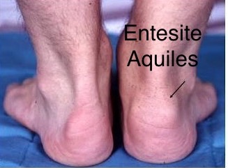 entesite Aquiles