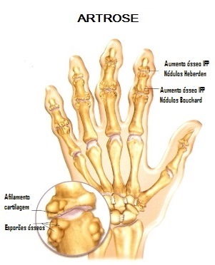 artrose e mão