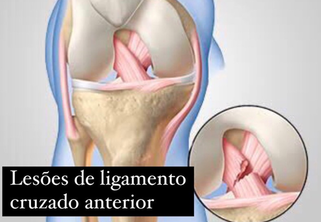 artrose e lesão ligamento cruzado