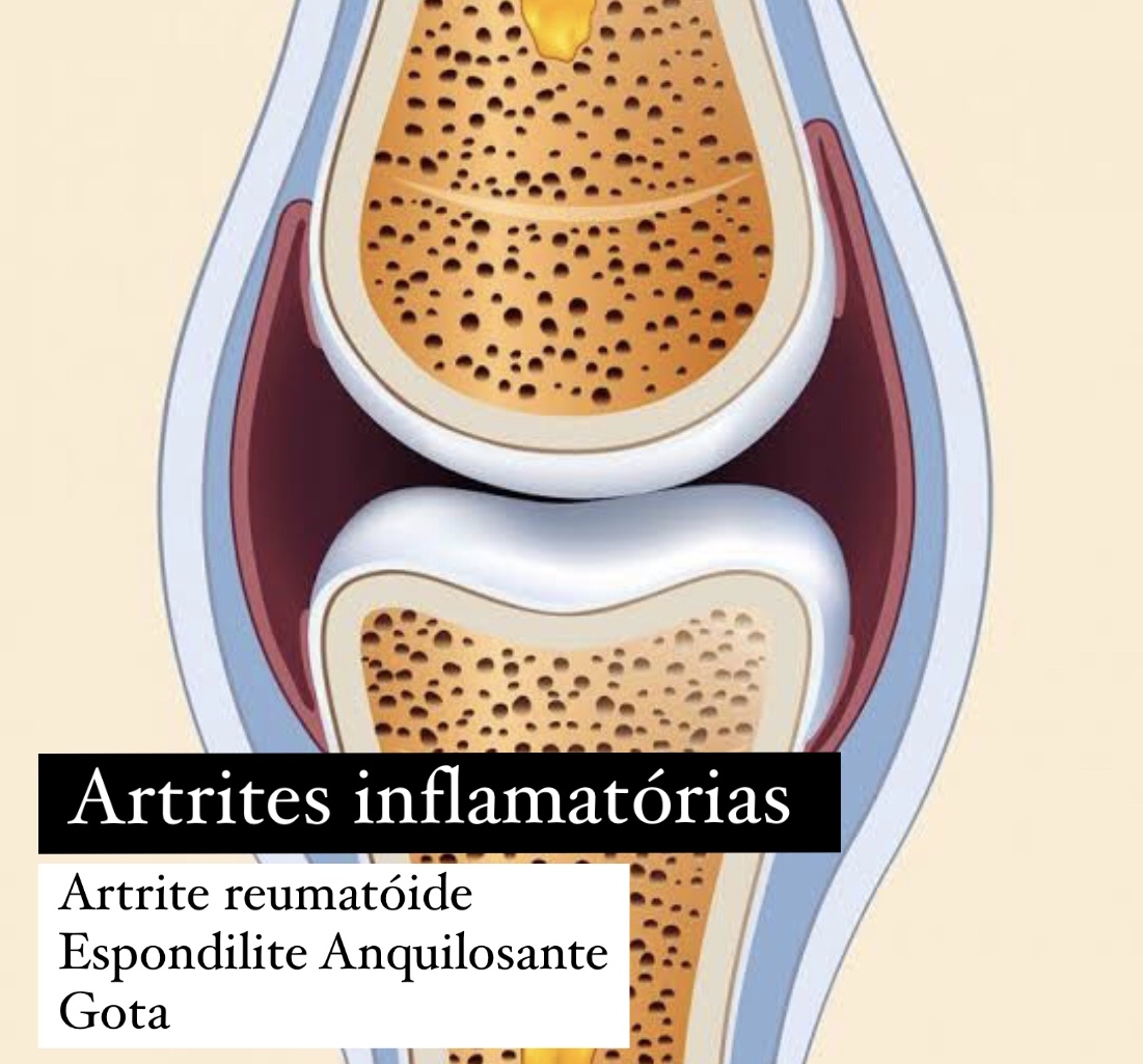 artrose e artrites