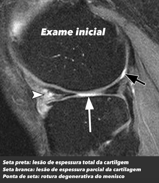 artrose de joelho e ressonância magnética