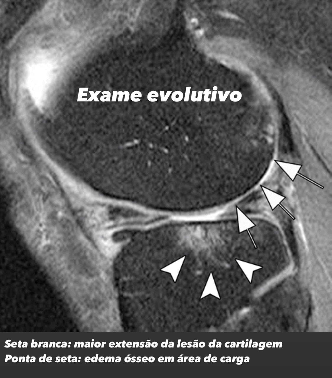 artrose de joelho e ressonância magnética