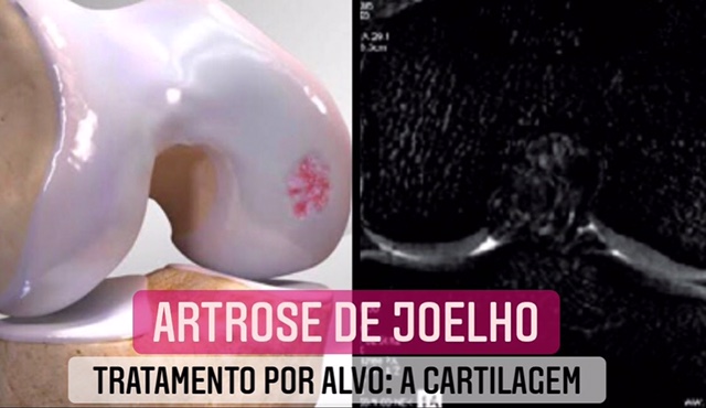 artrose de joelho e cartilagem