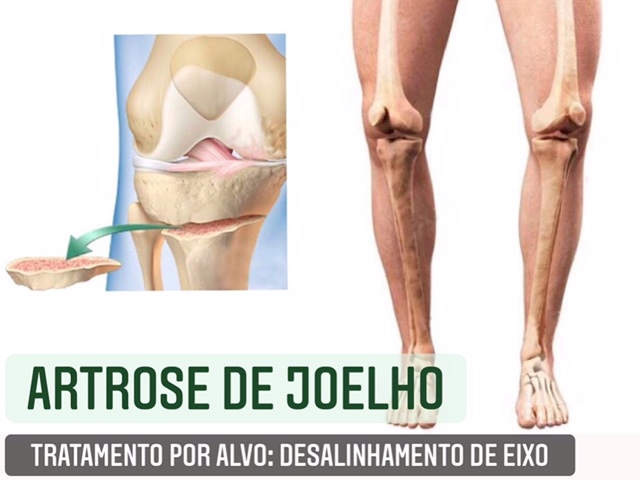 artrose de joelhos e genu varo e valgo