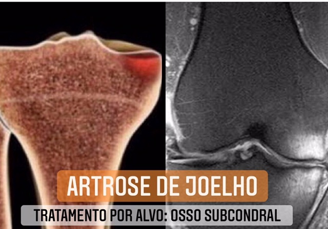 artrose de joelho e osso subcondral