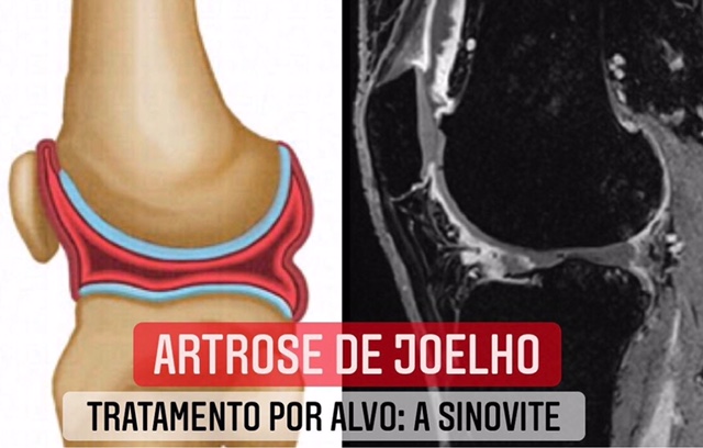 artrose de joelho e sinovite