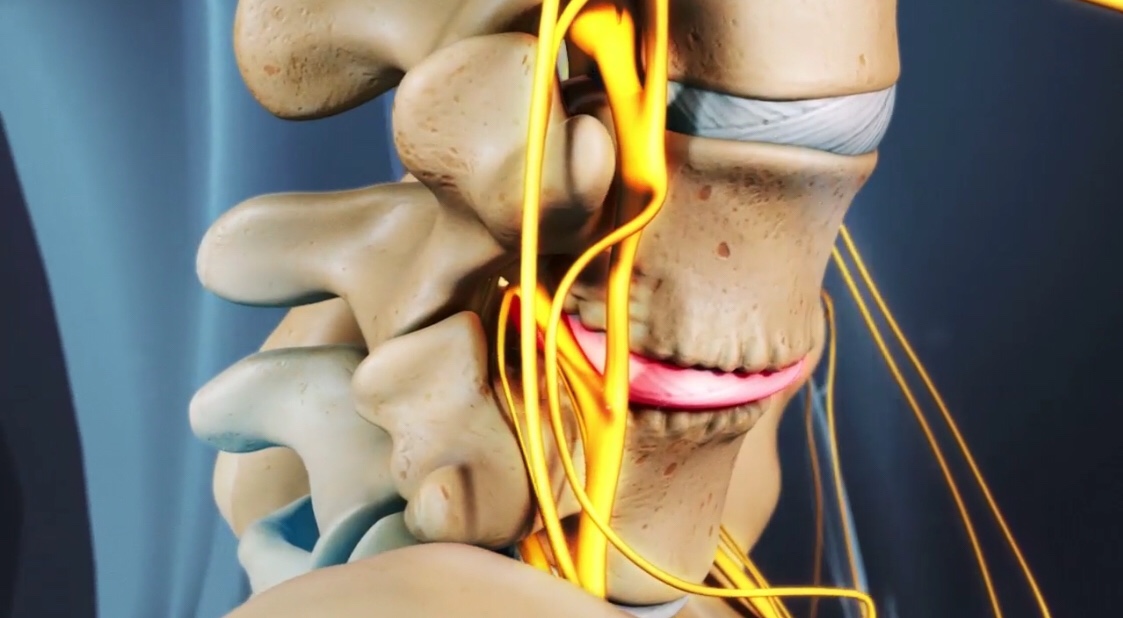 Espondiloartrose (artrose da coluna)
