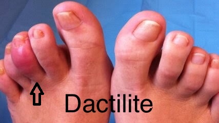 dactilite