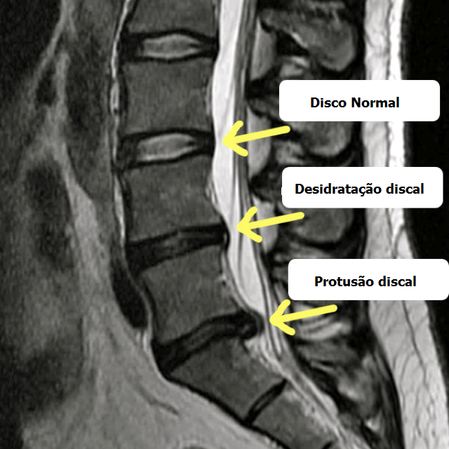 Degeneração discal 