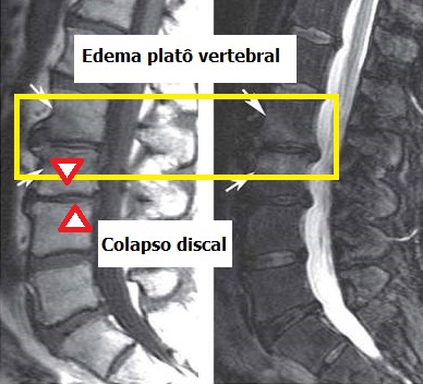 Degeneração discal e dor 