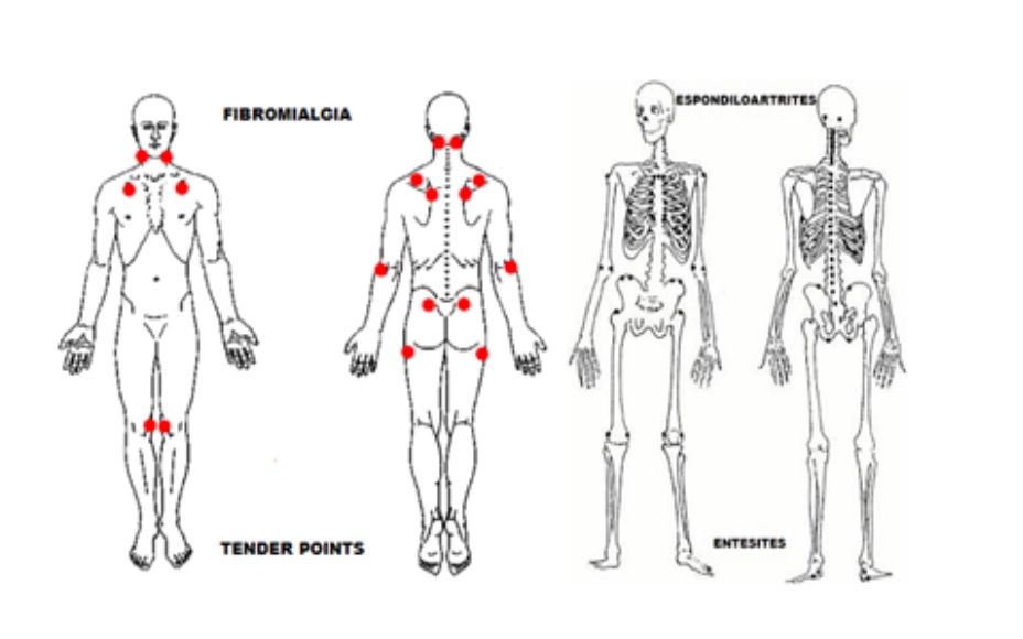 entesite e tender points