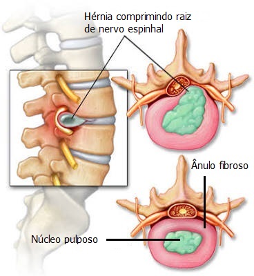 Como surge a hérnia de disco 