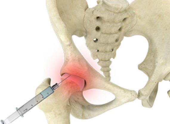 artrose quadril