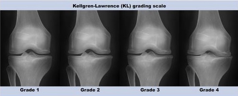 grau da artrose de joelho 
