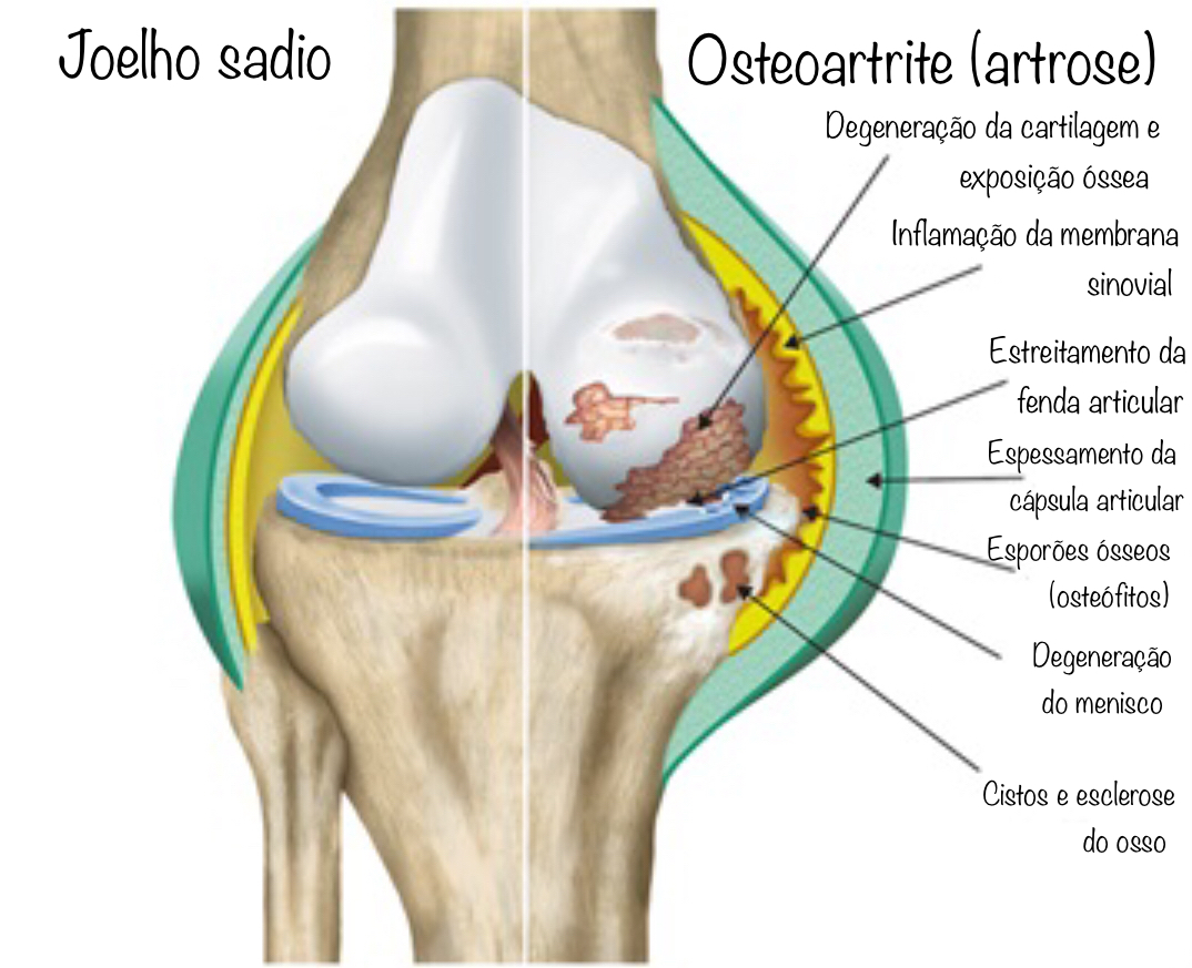 o que é artrose