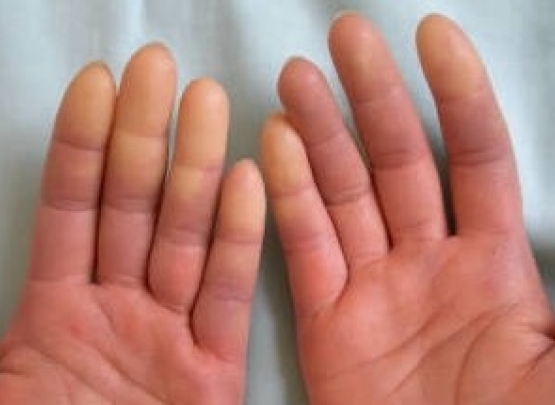 Fenômeno de Raynaud: atenção para reumatismo 