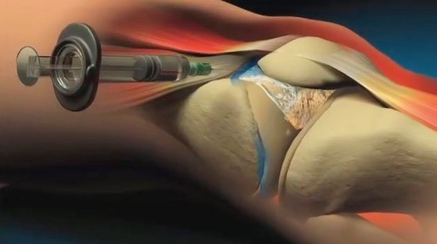 infiltração articular artrose de joelho 