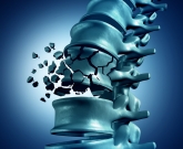 osteoporose