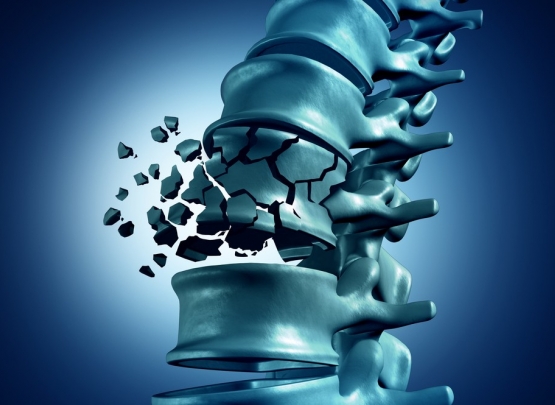 osteoporose