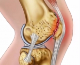 sindrome patelofemoral