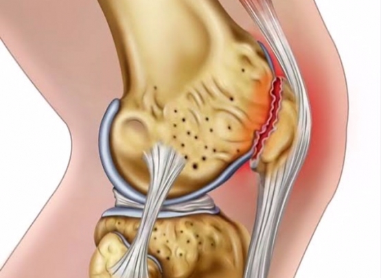 sindrome patelofemoral