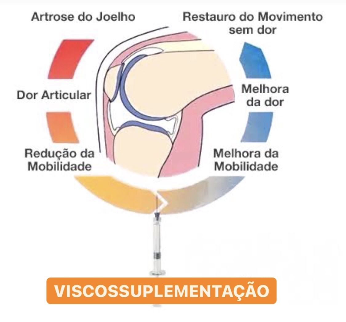 viscossuplementação