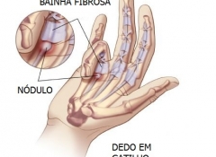 gatilho
